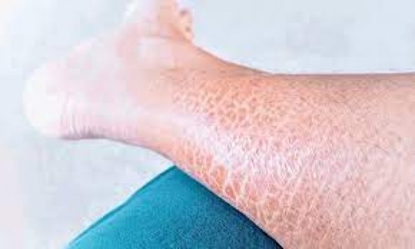 फिश स्केल स्किन से छुटकारा पाने के लिए अपनाएं ये उपाय
