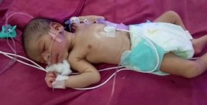 जानलेवा गड्ढे में गिरकर जिंदगी और मौत के बीच जूझ रहा नवजात शिशु