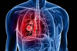 होम्योपथी से करें किडनी और फेफड़ों का इलाज