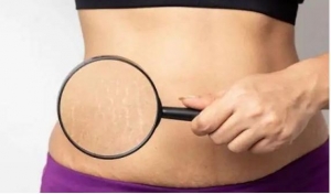 पेट और जांघों के स्ट्रेच मार्क्स को करना है दूर, घरेलू नुस्खे